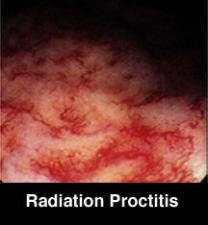 Radiation Proctopathy : Radiation proctitis: Clinical manifestations ...