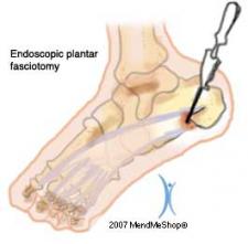 Fasciotomy | Encyclopedia.com
